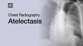 Chest Radiography Atelectasis [upl. by Yna]