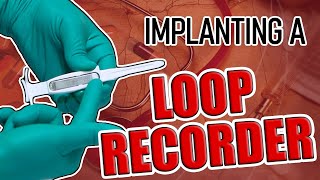 Loop Recorder Implant Procedure [upl. by Marge468]