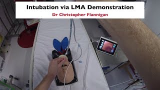 Intubation via LMA Demonstration [upl. by Oibirot385]