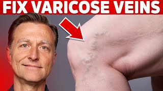 How to Treat Varicose Veins Naturally – Dr Berg [upl. by Ahsitauq421]