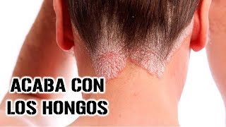 Tratamiento para la dermatitis seborreica y caspa [upl. by Dugan]